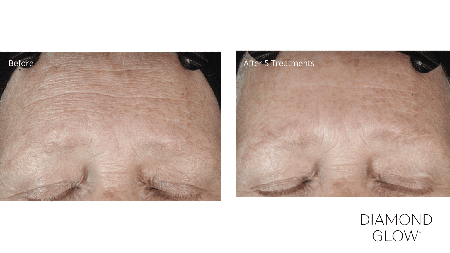 DiamondGlow Facial