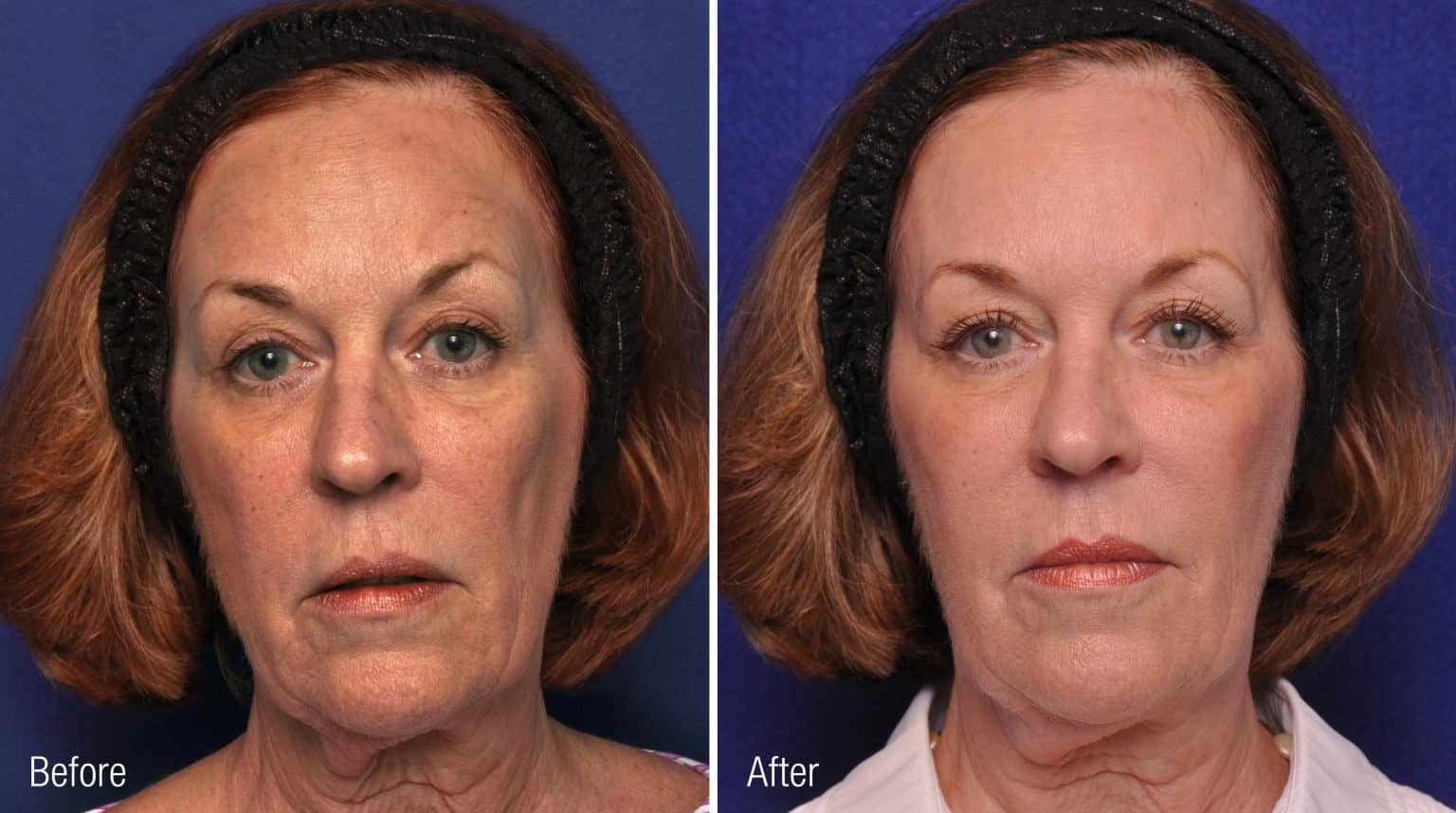 Face 8 Before After Photos Renuva 1536x858