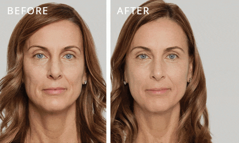 sculptra before and after 3 768x459
