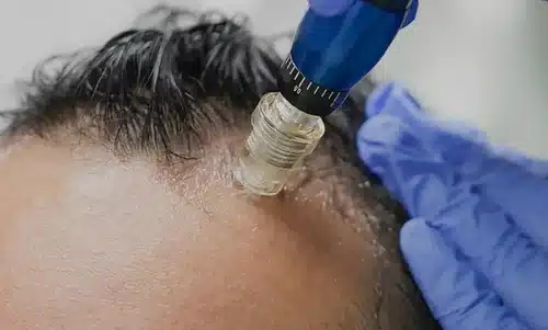 microneedling for hair loss 500x500